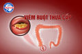 Viêm ruột thừa cấp