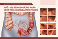 Báo cáo ca lâm sàng: đa Polyp mũ ở đại trực tràng được điều trị bằng phương pháp diệt trừ Helicobacter Pylori