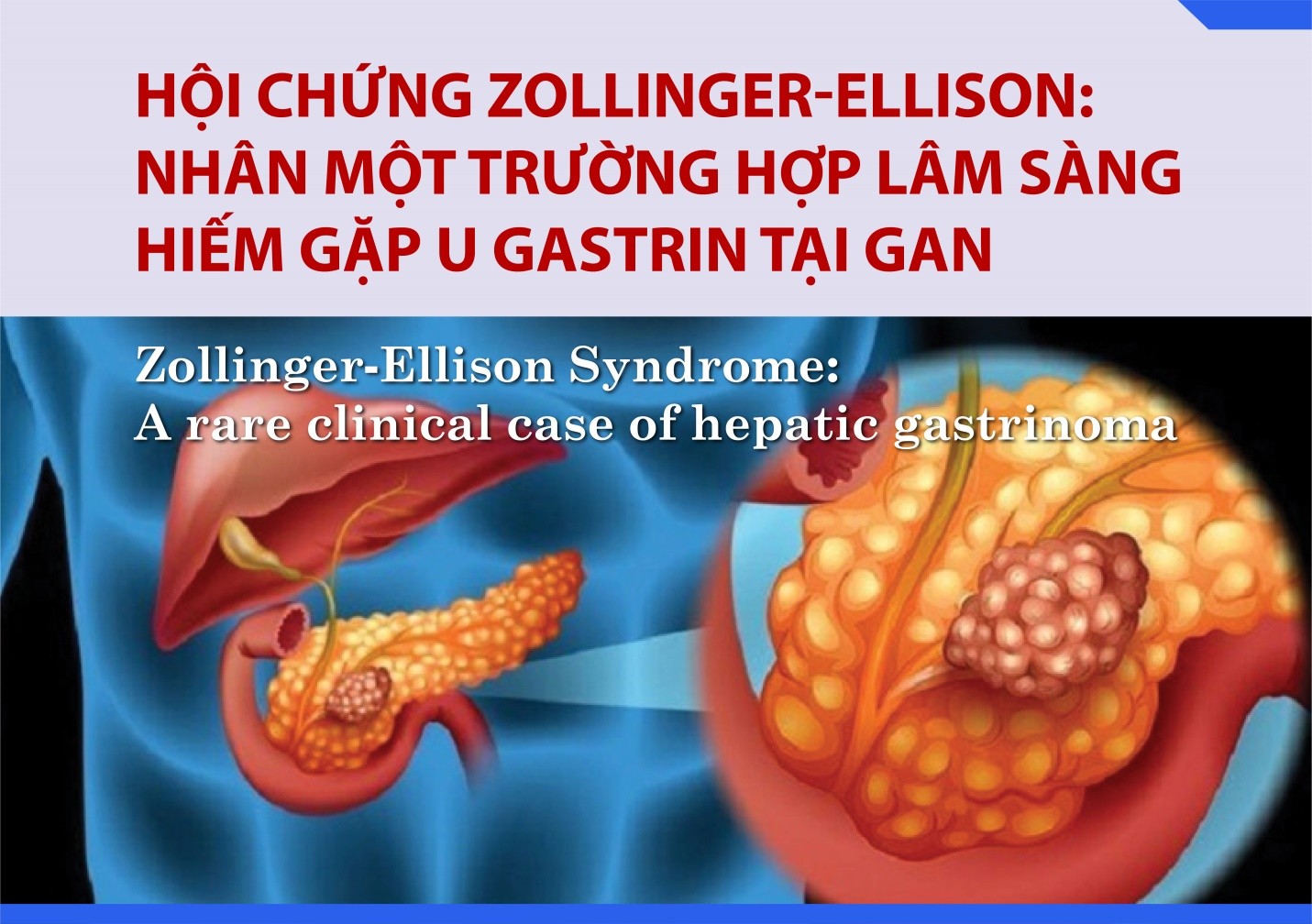 Hội chứng Zollinger-Ellison: Nhân một trường hợp lâm sàng hiếm gặp u gastrin tại gan