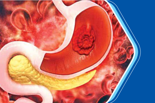 Đồng thuận hướng dẫn điều trị chảy máu tiêu hóa trên không do tăng áp lực tĩnh mạch cửa.